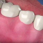 3 educational videos for dental implant patients
