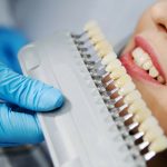 how to make your patients want to whiten with you