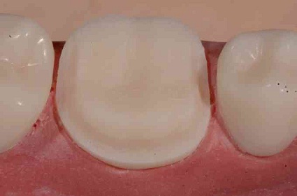 cerec tessera workflow cerec tessera workflow