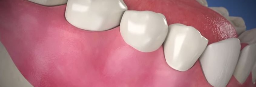 3 educational videos for dental implant patients